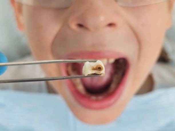 Best Knocked-Out Tooth (Avulsed Tooth) Treatment in Junction City, KY