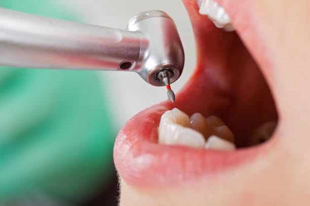 Best Knocked-Out Tooth (Avulsed Tooth) Treatment in Junction City, KY
